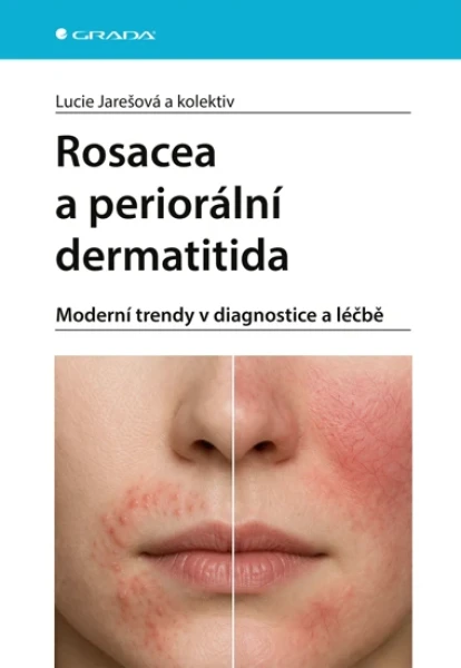 Rosacea a periorální dermatitida, Jarešová Lucie