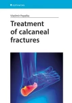Treatment of calcaneal fractures, Popelka Vladimír