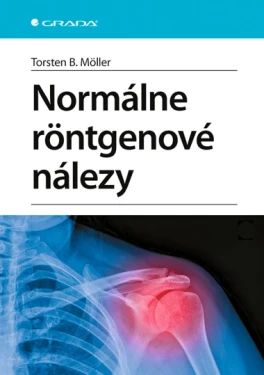 Normálne röntgenové nálezy, Moller B. Torsten