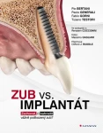 Zub vs. implantát, Bertani Pio